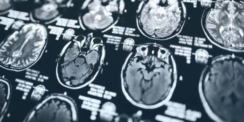 Radiografía del cerebro