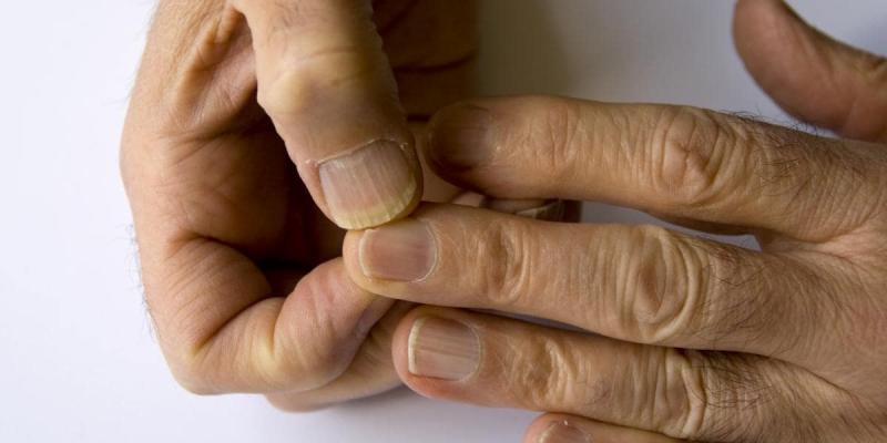 Síntomas de cáncer en las uñas