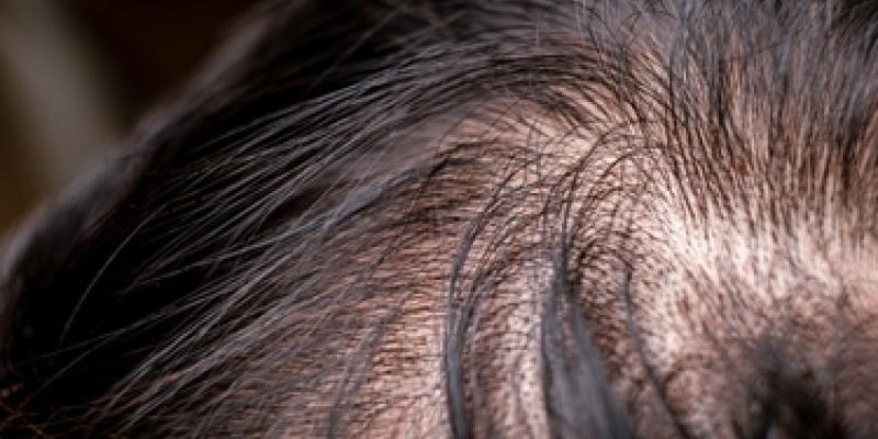 Cómo cuidar el cuero cabelludo