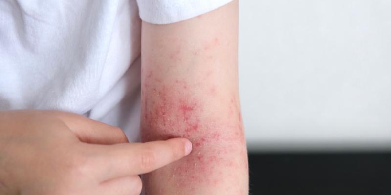 Niño con dermatitis que necesita Dupixent