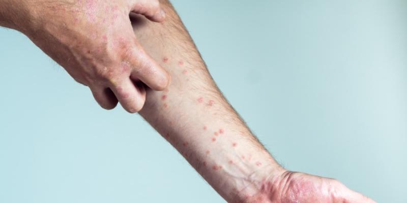 eczema