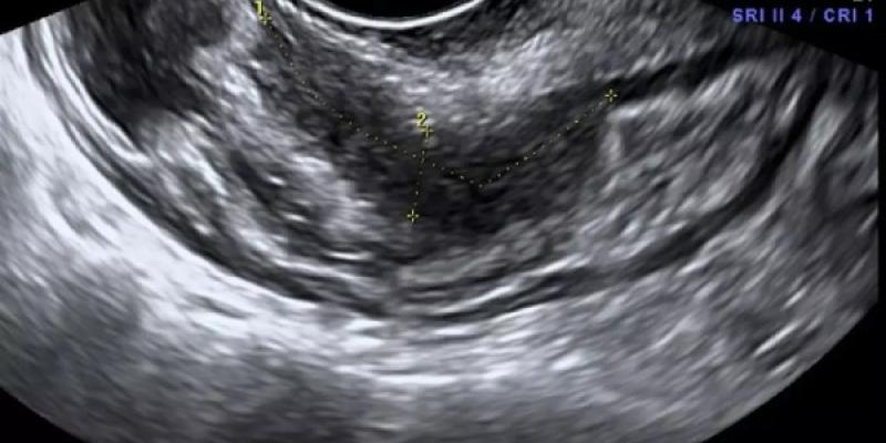 Endometrio tras una ecografía