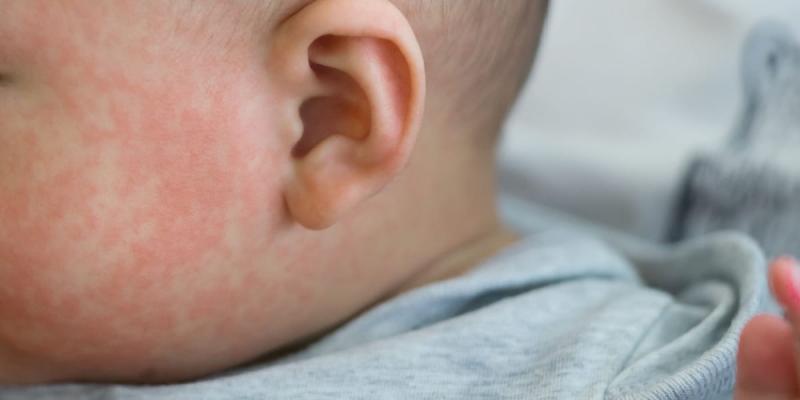 La enfermedad de Kawasaki en niños