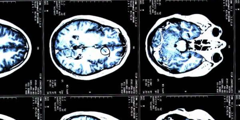 Imagen de una resonancia magnética