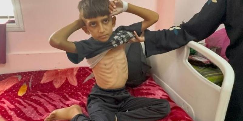 La infancia en Gaza con desnutrición 
