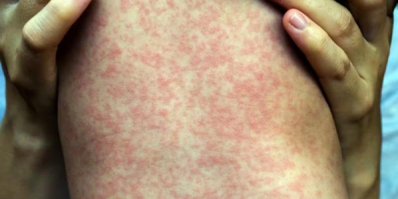 Resurge de forma preocupante el sarampión en el mundo