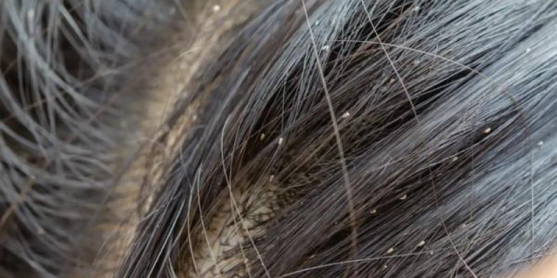 Los mejores trucos para prevenir los piojos.