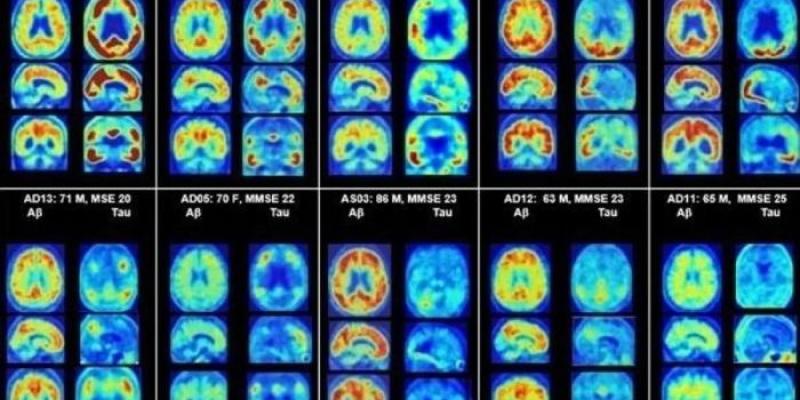 Imágenes de pacientes con Alzheimer