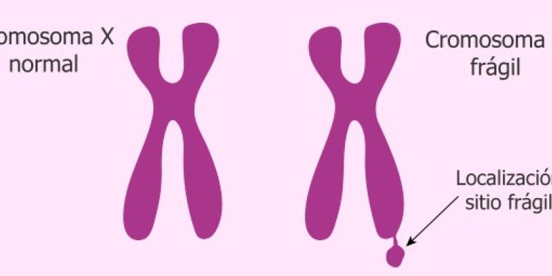 Así es el síndrome X frágil