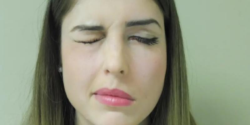 Mujer con parálisis facial