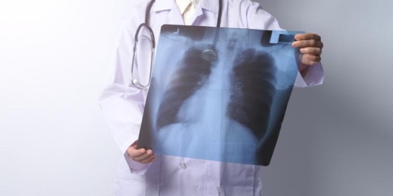 Radiografía de cáncer de pulmón