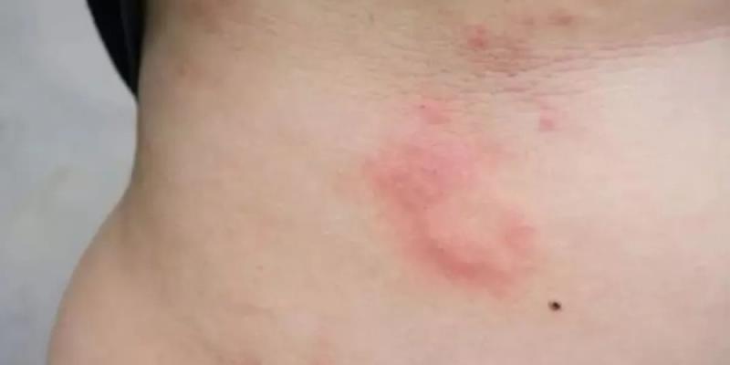 Persona con alergia en la piel