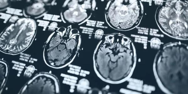 Radiografía del cerebro