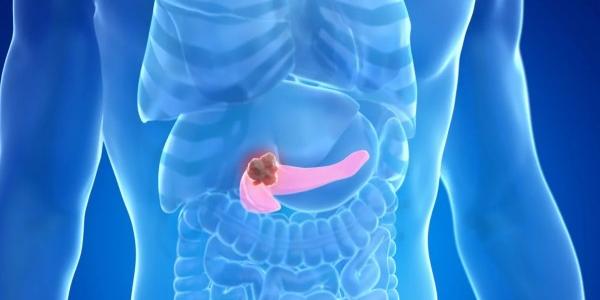 Infografía sobre el cáncer de páncreas