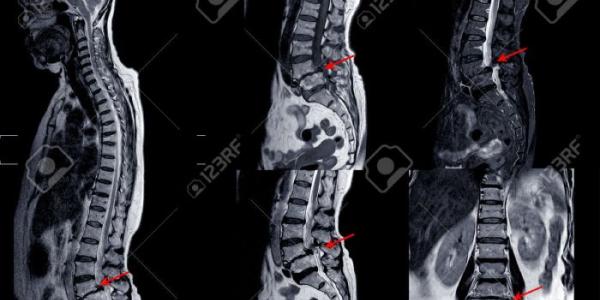 RNM de la columna lumbar que muestra una grave mielopatía medular 