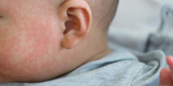 La enfermedad de Kawasaki en niños