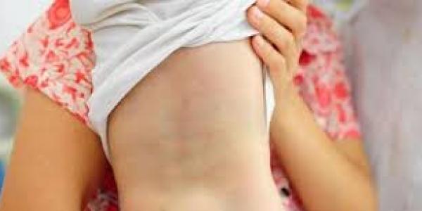 Niño con espina bífida