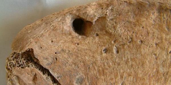 Mordedura en la cadera del gladiador, concretamente en la cadera