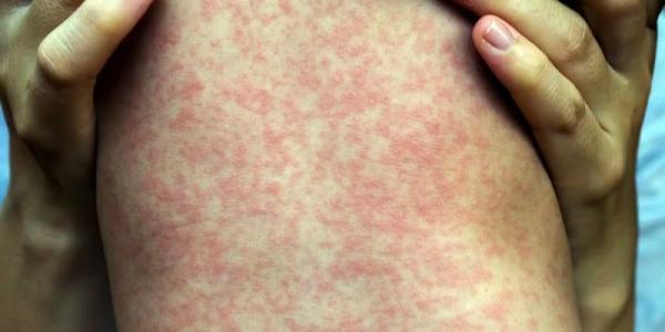 Resurge de forma preocupante el sarampión en el mundo