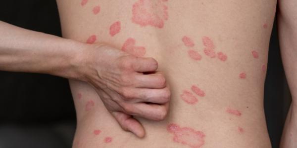 Psoriasis