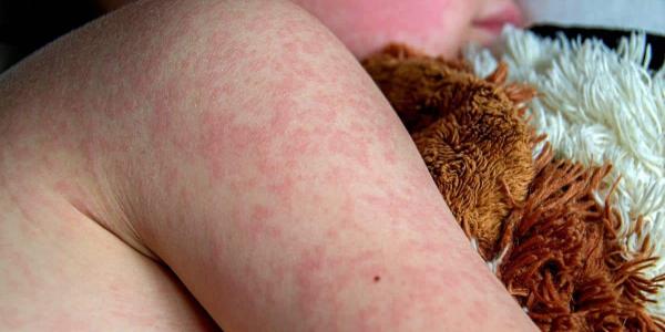 Aumentan los casos de sarampión