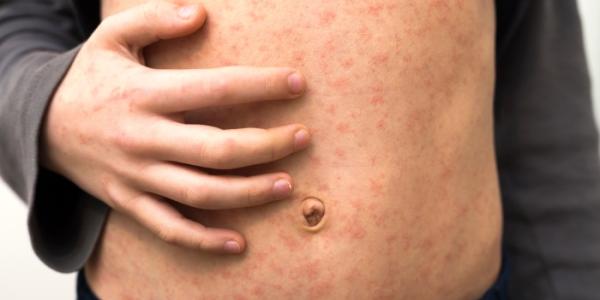 persona con sarampión