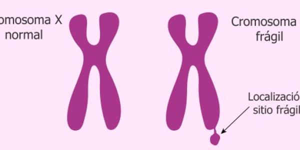 Así es el síndrome X frágil