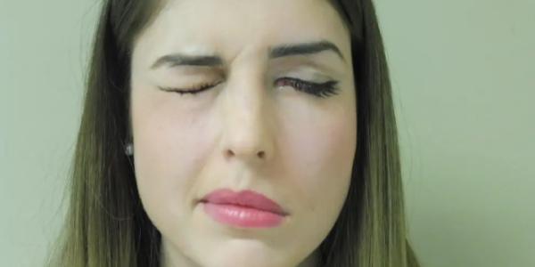 Mujer con parálisis facial