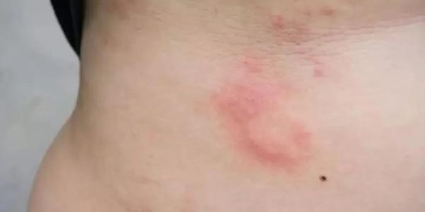 Persona con alergia en la piel