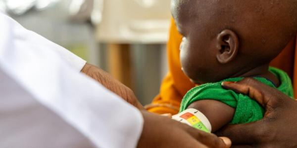 Niño con desnutrición infantil