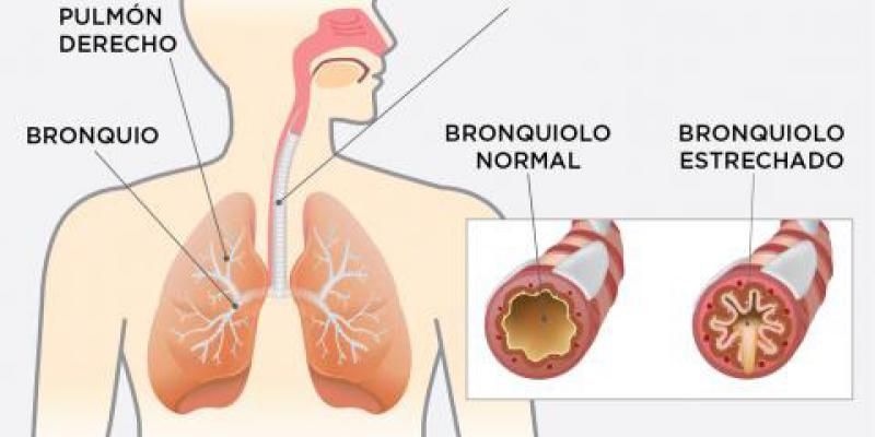 Los medicamentos recetados para el EPOC podrían ser efectivos para el COVID-19