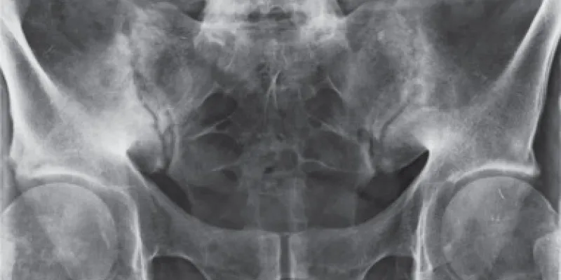 Radiografía de una mujer con espondiloartritis axial