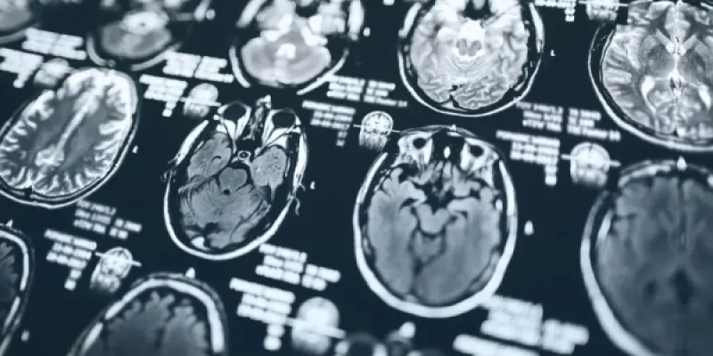 Radiografía del cerebro
