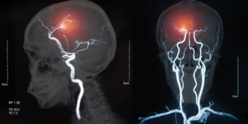 El calor extremo y el cerebro