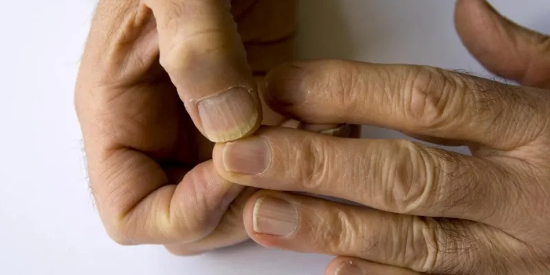Síntomas de cáncer en las uñas