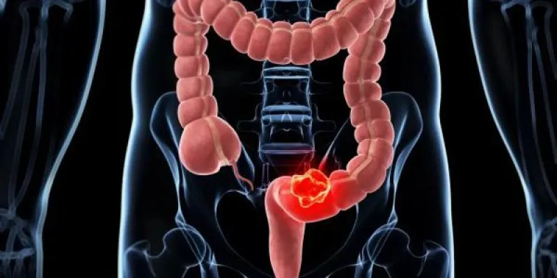 La causa del cáncer colorrectal en jóvenes