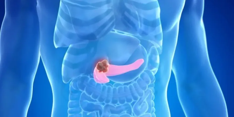 Infografía sobre el cáncer de páncreas