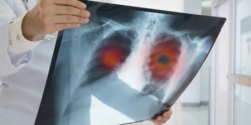 Encuesta sobre cáncer de pulmón