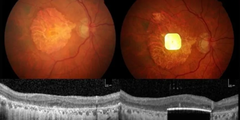 La imagen derecha muestra el chip en el ojo de un paciente 
