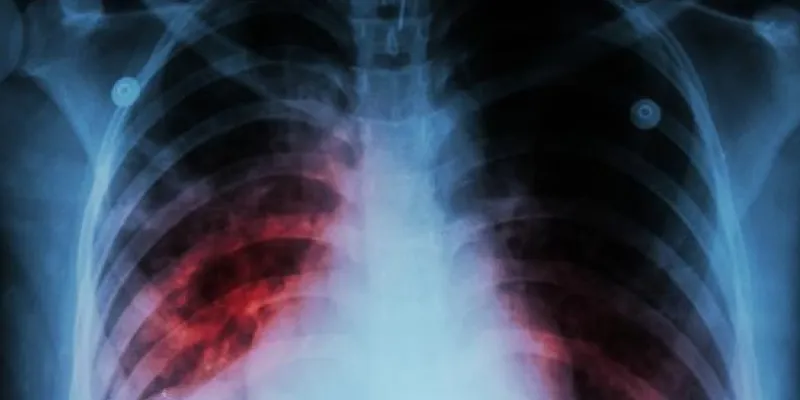 Radiografía de unos pulmones con tuberculosis