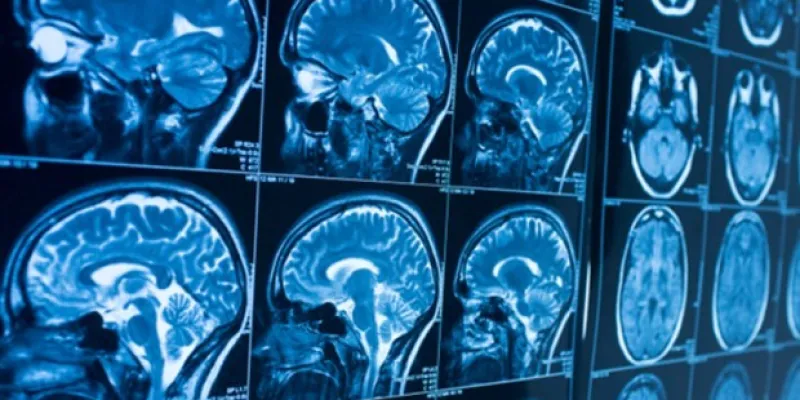 Algunas personas con Covid-19 desarrollan síntomas neurológicos 