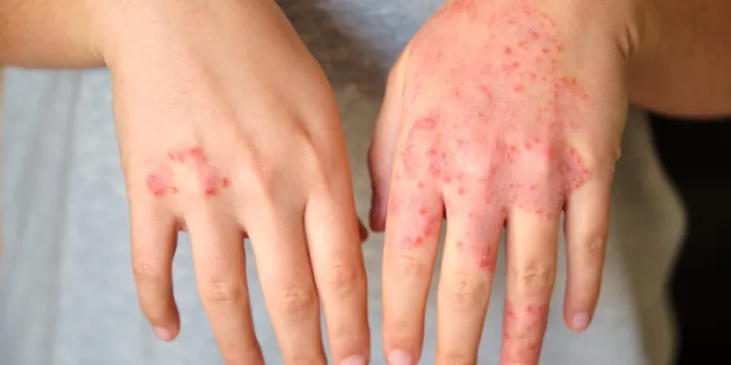 dermatitis atópica