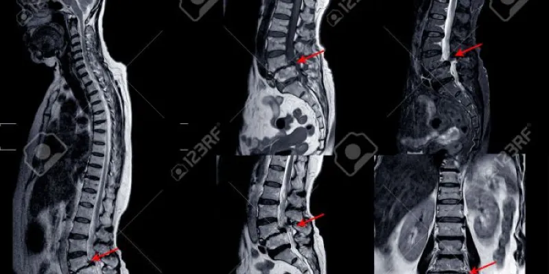 RNM de la columna lumbar que muestra una grave mielopatía medular 