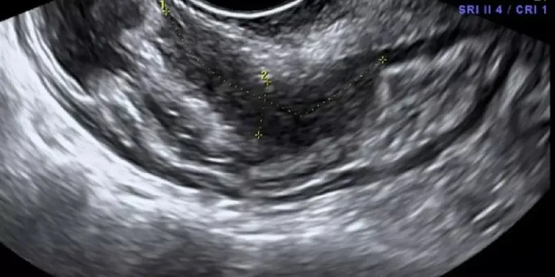 Endometrio tras una ecografía