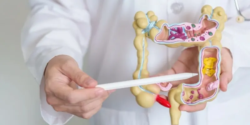 Enfermedad de Crohn
