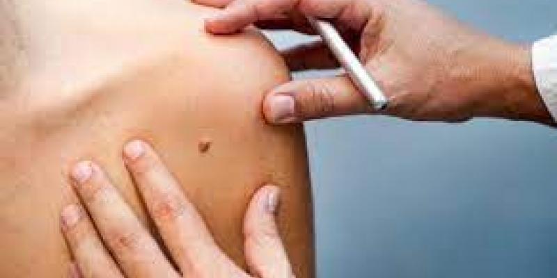 El melanoma es uno de los tumores más agresivos/Redacción médica