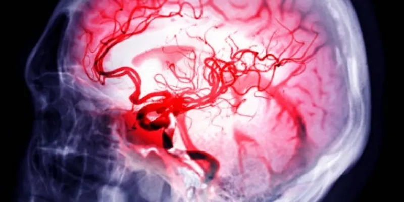 El cerebro que sufre un ictus