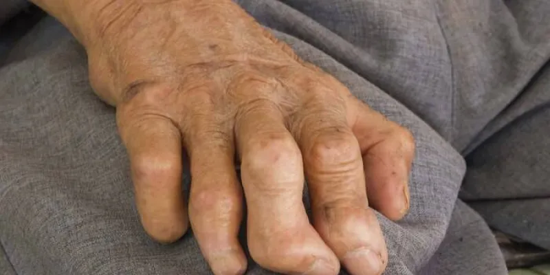El Día Mundial contra la Lepra 2021: Terminar con el estigma, la discriminación y el prejuicio