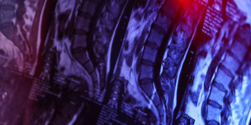 Lesiones medulares y avances