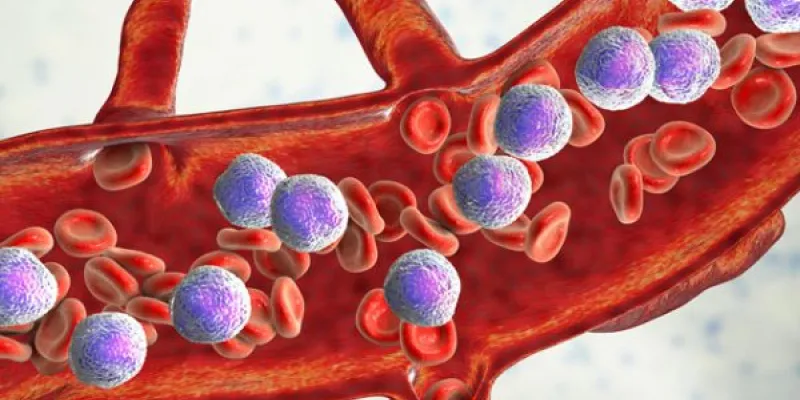 Leucemia linfoblástica aguda